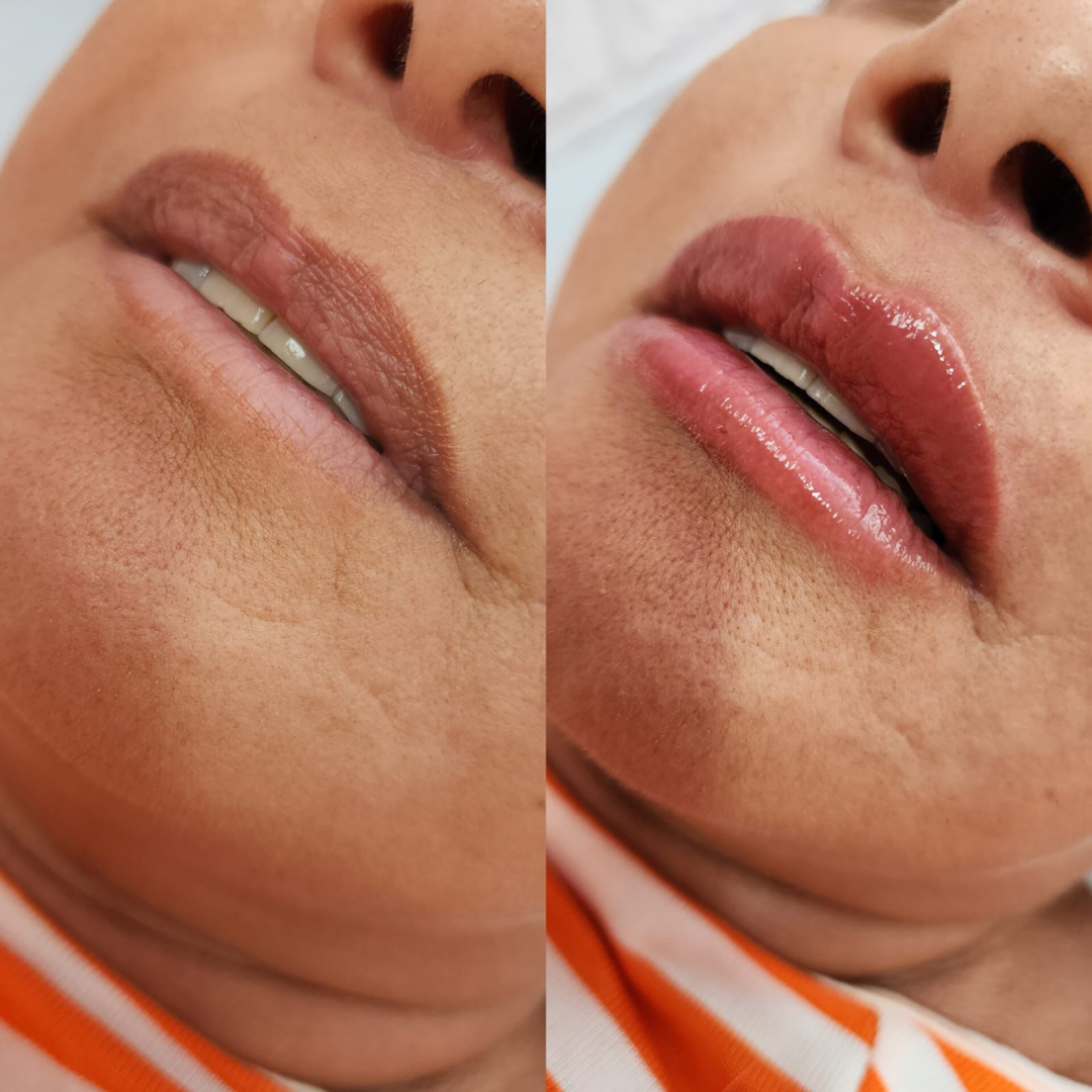 Antes de Depois 01